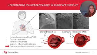 Recommendations and Rationale for the Treatment of Acute SCAD  Ana Iribarren MD [upl. by Grethel]