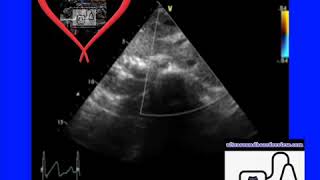 Ultrasound Board Review on Situs Inversus Corrected Transposition of the Great Arteries Ped Echo [upl. by Nnainot]