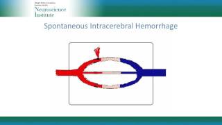 Management Principles for Spontaneous Intracerebral Hemorrhage [upl. by Ruhtua889]