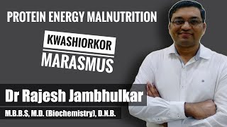 PROTEIN ENERGY MALNUTRITION PEM Kwashiorkor and Marasmus [upl. by Caneghem]