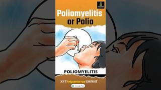 Poliomyelitis Hindi  Polio  Polio Virus  Causes Signs and Symptoms Polio Poliomyelitis [upl. by Tloc]