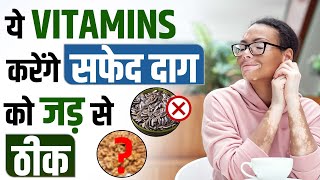 Safed daag kis vitamin ki kami se hote hai  सफेद दाग के लिए क्या करें  Safed Daag ka Ilaj [upl. by Edee]