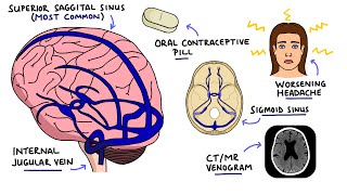 Cerebral Venous Sinus Thrombosis CVST  With Dural Venous Sinuses Anatomy [upl. by Anelliw]