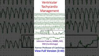 Ventricular Tachycardia Management [upl. by Elocn]