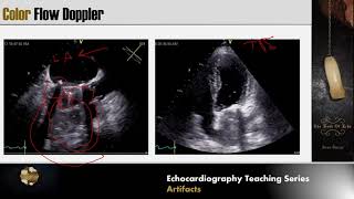 Lecture 14  Evaluation of Prosthetic Valves [upl. by Lleval]