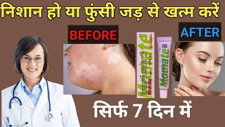 momate cream use in hindi mometasone cream [upl. by Onitnatsnoc]