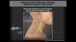 Image Guide Cervical Medial Branch Nerve Ablation [upl. by Molloy398]