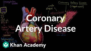 What is coronary artery disease  Circulatory System and Disease  NCLEXRN  Khan Academy [upl. by Aitercul593]