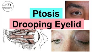 Ptosis Drooping Eyelid  Eye Anatomy Causes Associated Conditions Diagnosis amp Treatment [upl. by Avehstab]