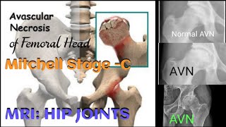 Avascular Necrosis of Femoral Head  Mitchell Stage  C  MRI HIP JOINTS [upl. by Itsa]