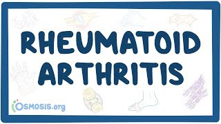 Rheumatoid arthritis  causes symptoms diagnosis treatment pathology [upl. by Zanlog]