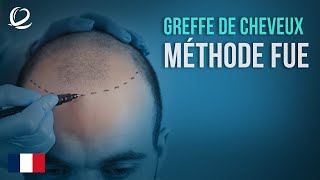 Méthode de greffe de cheveux FUE à Clinicana Istanbul Turquie [upl. by Nyliram]