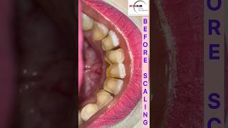 Teeth Cleaning by Doctor scaling teethcleaning dentist [upl. by Minor869]