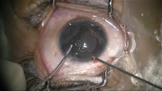 Triple treatment therapy for congenital stromal iris cyst [upl. by Willetta306]