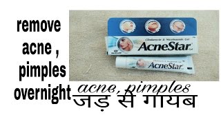 How To Remove Pimples From Face  with acnestar gel review hindi [upl. by Mauer]