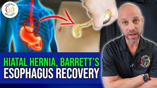 Hiatal Hernia and Barretts Esophagus Recovery with The Reflux Shield [upl. by Aramat]