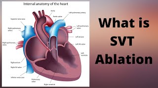 What is SVT Ablation [upl. by Tarrance]