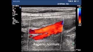 Corsi di ecocolordoppler dei TSA Tronchi Sovra Aortici1 [upl. by Rolan443]