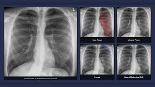 Simple Pneumothorax Explanation of Chest Xray Findings [upl. by Hgielah802]