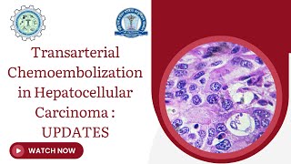 Transarterial Chemoembolization in Hepatocellular Carcinoma [upl. by Eoin215]