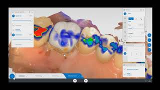 CEREC Crown Design Tooth 3 [upl. by Nerrak]