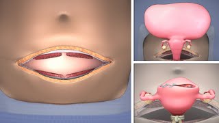 Abdominal Myomectomy through Maylard incision  TVASurg [upl. by Nidla]