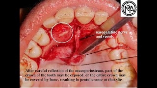 Surgical Extraction of palatally Impacted canine [upl. by Caspar]