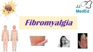 Fibromyalgia  Symptoms Associated Conditions Diagnosis Treatment [upl. by Icnarf659]