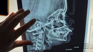 Demostration on Jarabaks Cephalometric Analysis  DrRasiga Gandhi  Department of Orthodontics [upl. by Ybrad]