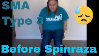 Before Spinraza SMA Type 3 Adult [upl. by Eirrotal]