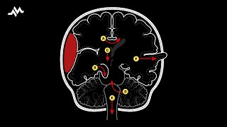 Brain Herniation Syndromes [upl. by Barnie]