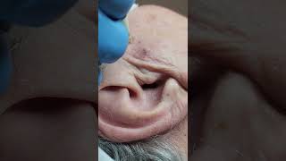 Seborrheic Keratosis Removal Philadelphia [upl. by Notlil]