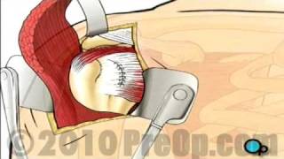 Rotator Cuff Repair Open Surgery [upl. by Yecac]