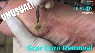 SCAR CORN ON DIABETIC FOOTΑΦΑΙΡΕΣΗ ΚΑΛΟΥ ΤΥΛΟΥΚέντρο Ποδιού PodiatryΠοδιατρική ΠοδολογίαΑθήνα [upl. by Smailliw279]