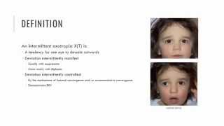 Intermittent Exotropia Characteristics [upl. by Ardek157]