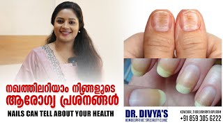 നഖത്തിലറിയാം നിങ്ങളുടെ ആരോഗ്യപ്രശ്നങ്ങൾ  Your Nails Can Tell About Your Health  Nails Warning [upl. by Koorb]