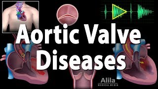 Aortic Valve Disease Animation [upl. by Siramay61]