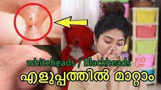 How to remove blackheads amp whiteheads easily at home in Malayalam 💯 [upl. by Tiersten500]