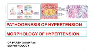 Hypertension  Pathogenesis  Morphology  Arteriosclerosis [upl. by Ilrebmyk]