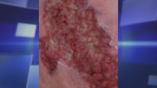 Pyoderma Gangrenosum – Could It Happen To You [upl. by Schuster997]