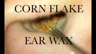 EAR WAX EWMOVAL  CORN FLAKES  4KHD [upl. by Aidul]