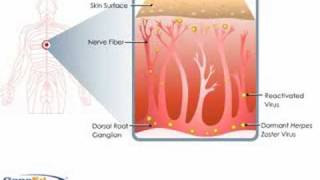 Shingles Pathophysiology [upl. by Eesac219]