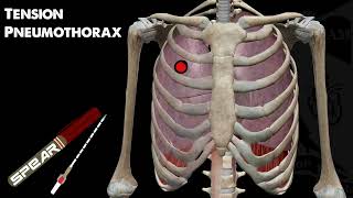 Tension Pneumothorax Education and Management [upl. by Vitus549]