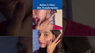 Transforming Skin with Kumkumadi Tailam Before amp After Results Revealed [upl. by Oilime]