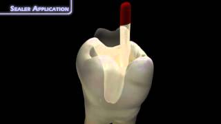 Sealer Application  Dentsply Sirona [upl. by Rubinstein698]