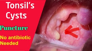 Tonsil Cyst White thing over tonsil Symptoms and management No antibiotics needed [upl. by Radnaxela]