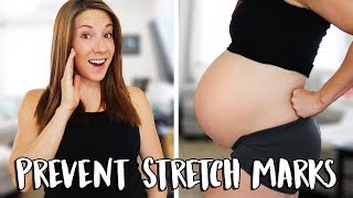 5 Effective Home Remedies for Pregnancy Stretch Marks [upl. by Omora]