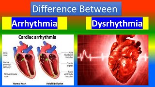 ARRHYTHMIA Vs DYSRHYTHMIA [upl. by Haerdna]