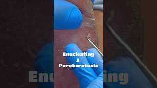 Enucleating A Porokeratosis [upl. by Lomasi678]