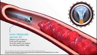 JETi Hydrodynamic Thrombectomy System Method of Action MOA Animation [upl. by Yahsel]